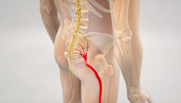 سیاتیک چیست و چه علایمی دارد؟